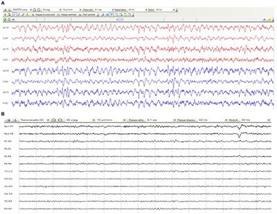 Newly Diagnosed Hepatic Encephalopathy Presenting as Non-convulsive Status Epilepticus: A Case Report and Literature Review